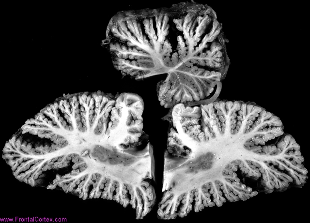 Cerebellar Sclerosis